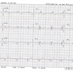 EKG-4