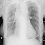 Chestxray