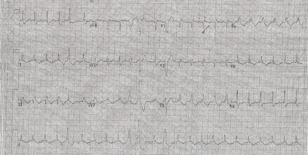 ekg atach