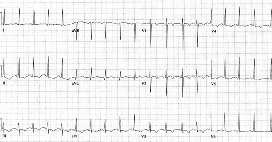 ekg