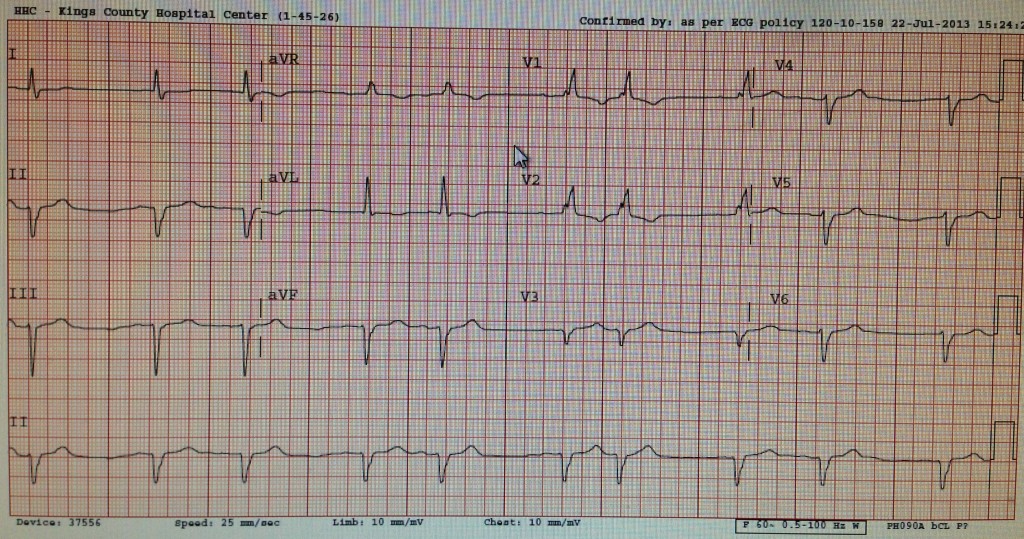 8_13_ekg